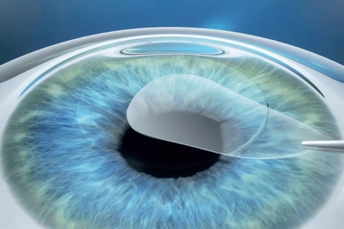 Bilim insanları, sağlam korneadan ilaç geçişini ilk kez doğrudan ölçtü.