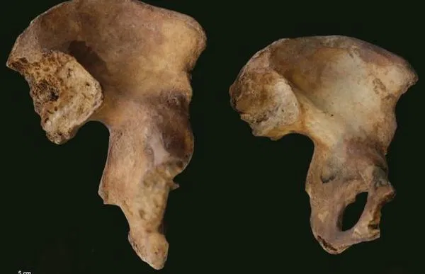 İskeletlerdeki İzler Ne Anlatıyor? Yaşlanma ile Hastalık Arasındaki İnce Çizgi