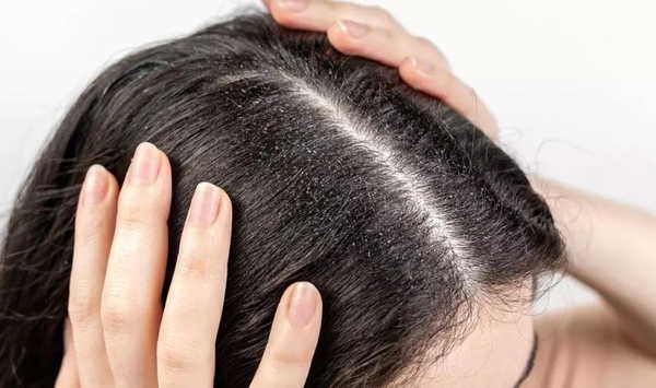 Kepek Sorununa Doğal Yaklaşım: Saç Derisini Rahatlatan 7 Etkili Yöntem