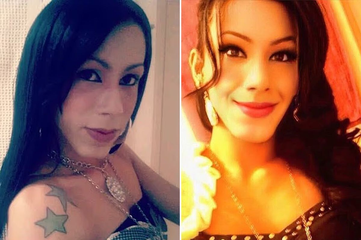 Yanlış Dolgu Uygulaması Genç Kadının Yüzünde Kalıcı Hasara Yol Açtı