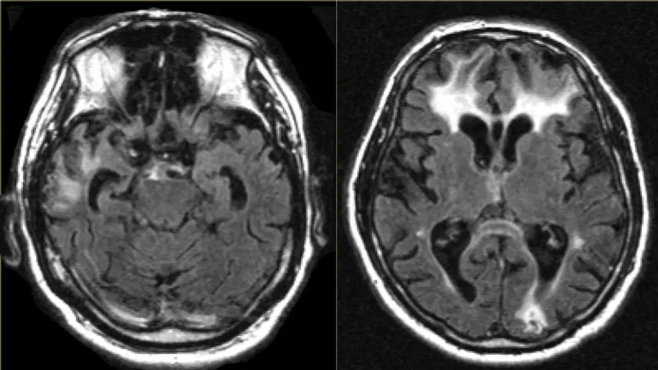 Alzheimer araştırmalarında çığır açan gelişme: Beynin “temizlik sistemi” yeniden düzenlendi